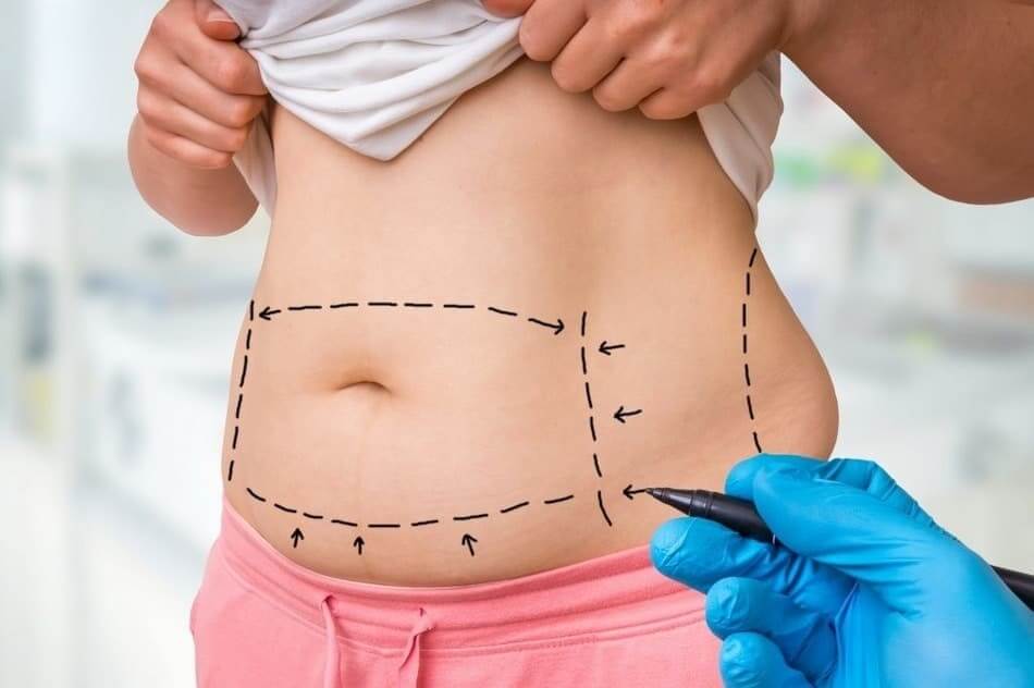 جراحی زیبایی شکم یا عمل ابدومینوپلاستی چیست؟ (1) | نحوه جراحی زیبایی شکم