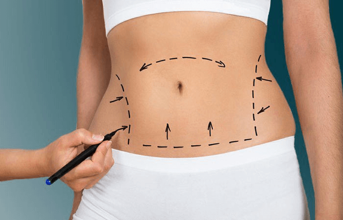 جراحی زیبایی شکم یا عمل ابدومینوپلاستی چیست؟ (2) | عمل ابدو