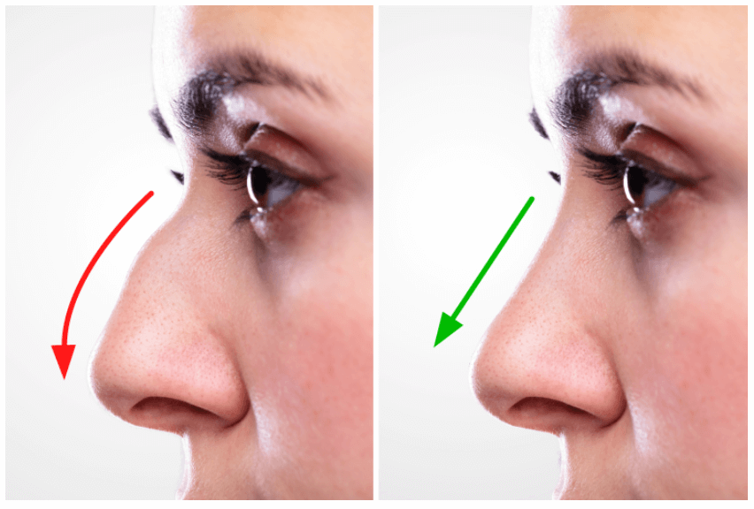 جراحی زیبایی بینی یا رینوپلاستی (2)