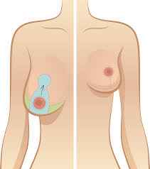 جراحی لیفت سینه یا ماستوپکسی (3)