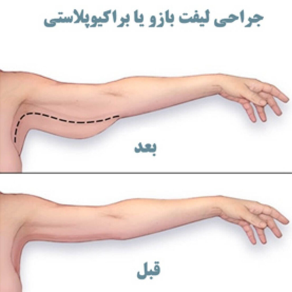 جراحی لیفت بازو یا براکیوپلاستی (3)