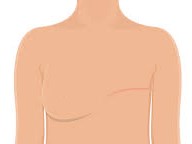 ماستکتومی یا عمل جراحی برداشتن سینه چیست؟ (1)