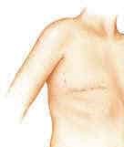 ماستکتومی یا عمل جراحی برداشتن سینه چیست؟ (4)