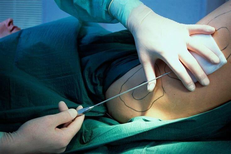 جراحی زیبایی لیفت ران (3)